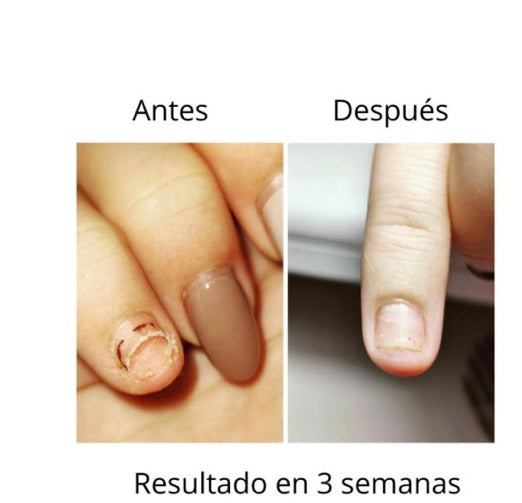 NAILSOFTHEDAY ONISTOP , ACEITE REGENERADOR PARA UÑAS CON ONICOLISIS, 8 ML