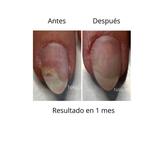 NAILSOFTHEDAY ONISTOP , ACEITE REGENERADOR PARA UÑAS CON ONICOLISIS, 8 ML