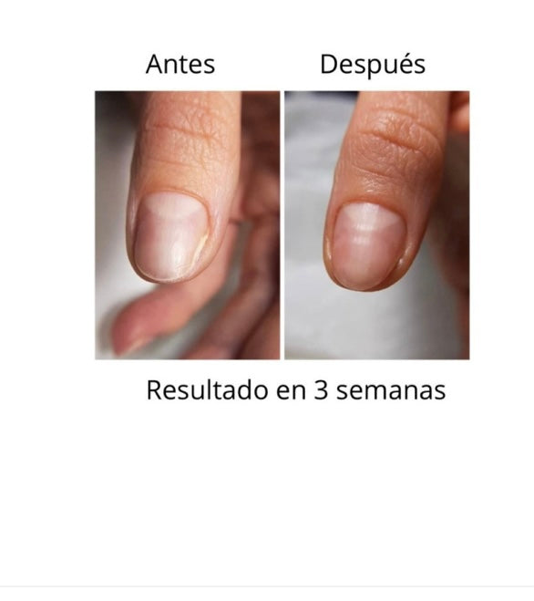 NAILSOFTHEDAY ONISTOP , ACEITE REGENERADOR PARA UÑAS CON ONICOLISIS, 8 ML