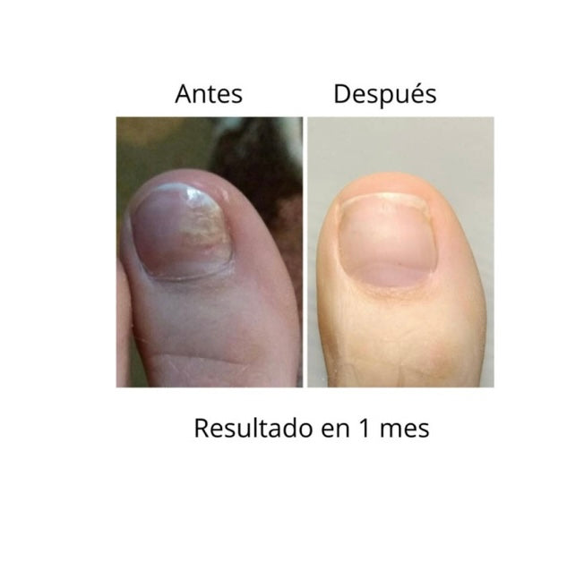 NAILSOFTHEDAY ONISTOP , ACEITE REGENERADOR PARA UÑAS CON ONICOLISIS, 8 ML